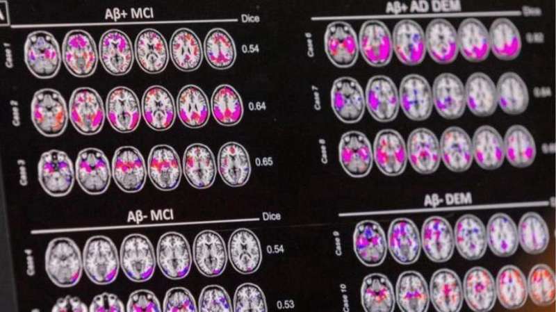 【技术深度】pTau217血液标志物:阿尔茨海默病早筛的精准革命与现实困境 新闻